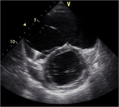 Continuous-flow left ventricular assist device treatment for arrhythmogenic right ventricular cardiomyopathy complicated by advanced biventricular failure – University of Tokyo experiences